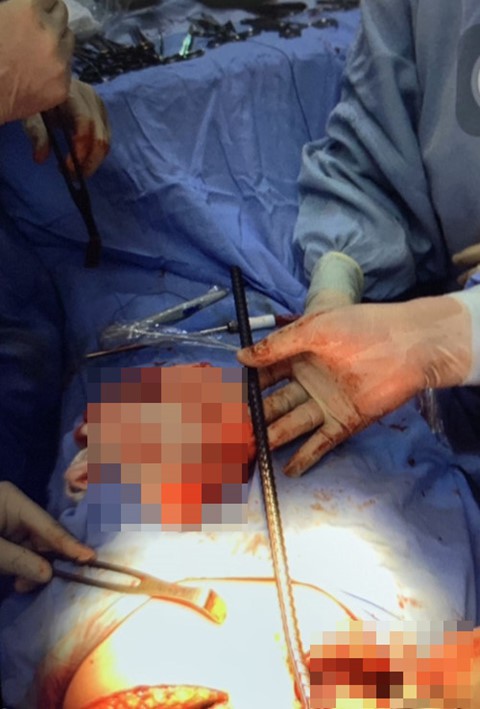 Cứu sống công nhân bị thanh sắt đâm xuyên lồng ngực - Ảnh 1. Cứu sống công nhân bị thanh sắt đâm xuyên lồng ngực - Ảnh 1.