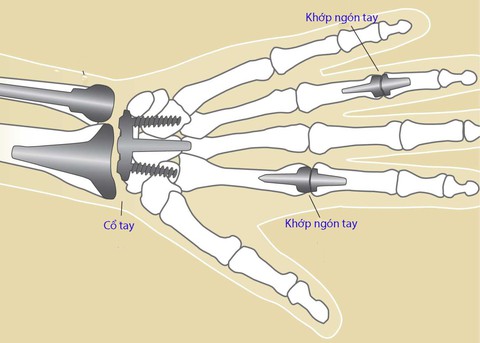 Viêm khớp ngón tay - Ảnh 1. Viêm khớp ngón tay - Ảnh 1.