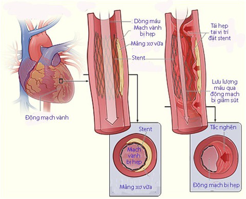 Tái hẹp sau nong mạch và đặt stent - Ảnh 1. Tái hẹp sau nong mạch và đặt stent - Ảnh 1.