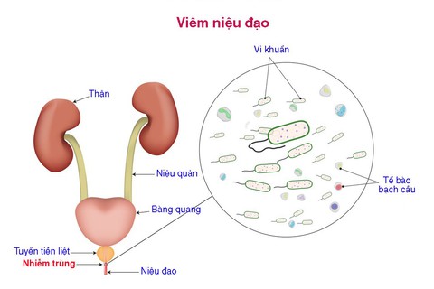 Viêm niệu đạo - Ảnh 1. Viêm niệu đạo - Ảnh 1.