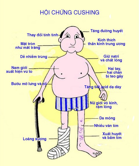 Hội chứng Cushing và bệnh Cushing - Ảnh 1. Hội chứng Cushing và bệnh Cushing - Ảnh 1.