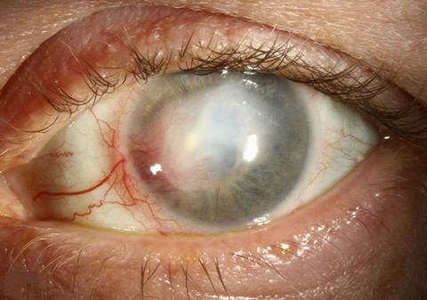 Viêm giác mạc herpes - Ảnh 1. Viêm giác mạc herpes - Ảnh 1.