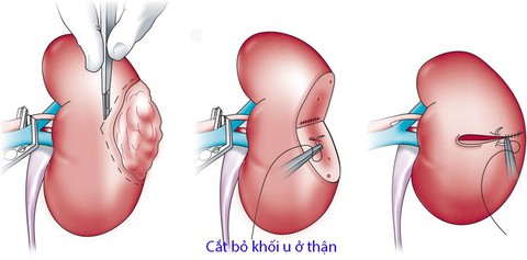 Ung thư thận - Ảnh 1. Ung thư thận - Ảnh 1.