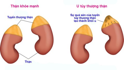 U tủy thượng thận - Ảnh 1. U tủy thượng thận - Ảnh 1.