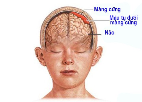 Máu tụ dưới màng cứng - Ảnh 1. Máu tụ dưới màng cứng - Ảnh 1.