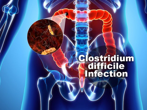 Nhiễm Clostridium Difficile - Ảnh 1. Nhiễm Clostridium Difficile - Ảnh 1.