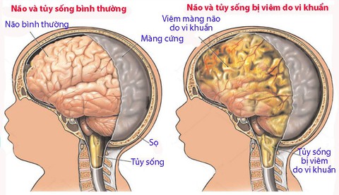 Viêm màng não sơ sinh - Ảnh 1. Viêm màng não sơ sinh - Ảnh 1.