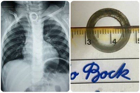 Bé 2 tuổi nuốt phải chiếc vòng kim loại có cạnh sắc - Ảnh 1. Bé 2 tuổi nuốt phải chiếc vòng kim loại có cạnh sắc - Ảnh 1.