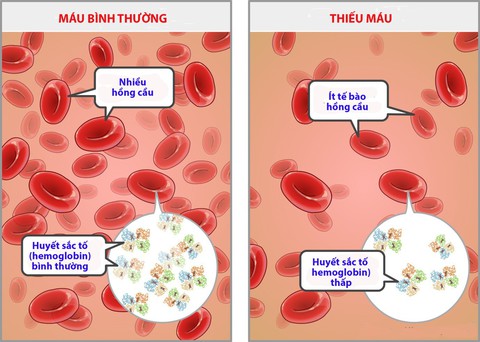 Bệnh thiếu máu do thiếu sắt ở trẻ sơ sinh - Ảnh 1. Bệnh thiếu máu do thiếu sắt ở trẻ sơ sinh - Ảnh 1.
