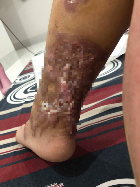 Khởi tố, bắt tạm giam cựu thiếu úy tạt axít vợ chưa cưới ở Đà Nẵng - Ảnh 2. Khởi tố, bắt tạm giam cựu thiếu úy tạt axít vợ chưa cưới ở Đà Nẵng - Ảnh 2.