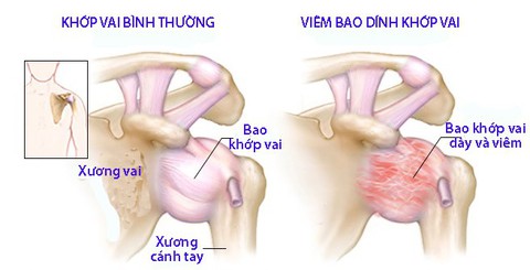 Viêm bao dính khớp vai - Ảnh 1. Viêm bao dính khớp vai - Ảnh 1.