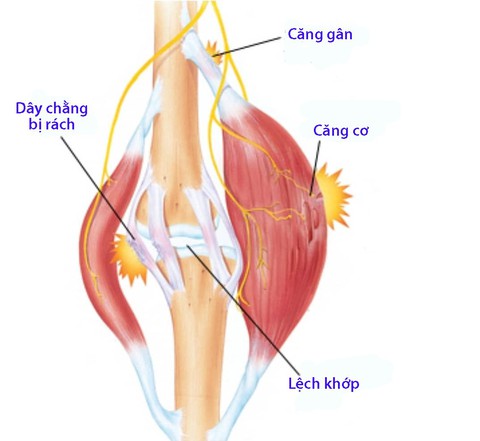 4 nhóm chấn thương thể thao thường gặp nhất - Ảnh 1. 4 nhóm chấn thương thể thao thường gặp nhất - Ảnh 1.