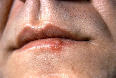 Herpes môi (mụn rộp môi) - Ảnh 1. Herpes môi (mụn rộp môi) - Ảnh 1.