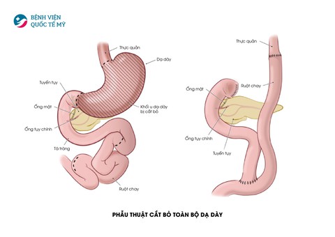 Hiểu về cơ chế điều trị ung thư thực quản, dạ dày - Ảnh 5. Hiểu về cơ chế điều trị ung thư thực quản, dạ dày - Ảnh 5.
