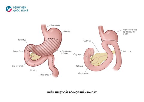 Hiểu về cơ chế điều trị ung thư thực quản, dạ dày - Ảnh 4. Hiểu về cơ chế điều trị ung thư thực quản, dạ dày - Ảnh 4.