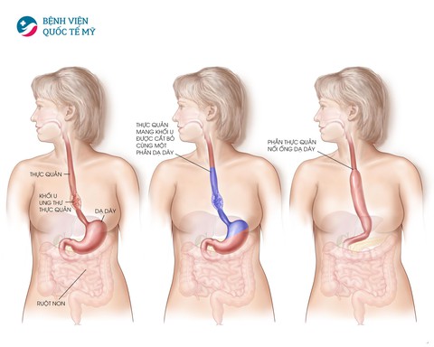 Hiểu về cơ chế điều trị ung thư thực quản, dạ dày - Ảnh 2. Hiểu về cơ chế điều trị ung thư thực quản, dạ dày - Ảnh 2.