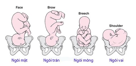 Sinh khó: Các vấn đề về đường dẫn sinh - Ảnh 1. Sinh khó: Các vấn đề về đường dẫn sinh - Ảnh 1.
