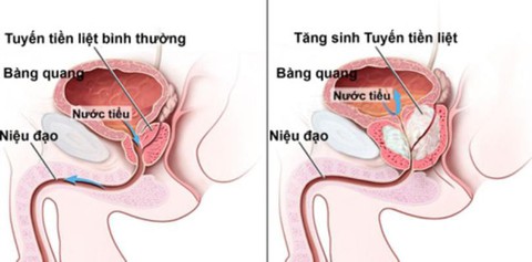 Đi tìm lời giải cho những băn khoăn khi chọn mua sản phẩm điều trị phì đại tuyến tiền liệt - Ảnh 1. Đi tìm lời giải cho những băn khoăn khi chọn mua sản phẩm điều trị phì đại tuyến tiền liệt - Ảnh 1.