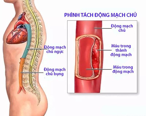 Bệnh phình tách thành động mạch chủ - Ảnh 1. Bệnh phình tách thành động mạch chủ - Ảnh 1.