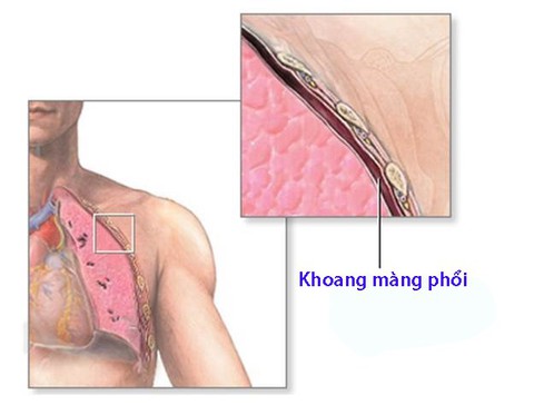 Viêm màng phổi - Ảnh 1. Viêm màng phổi - Ảnh 1.
