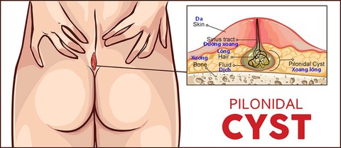 Bệnh nang lông dưới da vùng xương cùng cụt - xoang lông - Ảnh 1. Bệnh nang lông dưới da vùng xương cùng cụt - xoang lông - Ảnh 1.