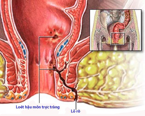 Bệnh Crohn quanh hậu môn - Ảnh 1. Bệnh Crohn quanh hậu môn - Ảnh 1.