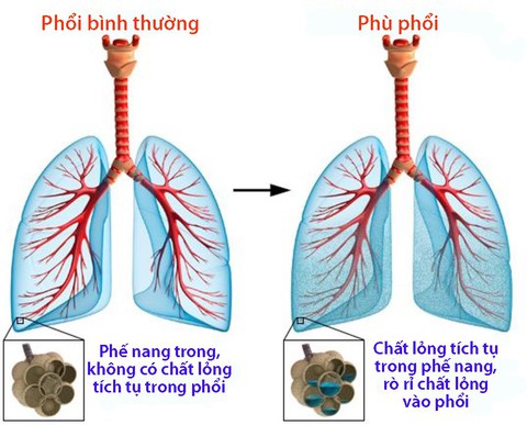 Phù phổi - Ảnh 1. Phù phổi - Ảnh 1.