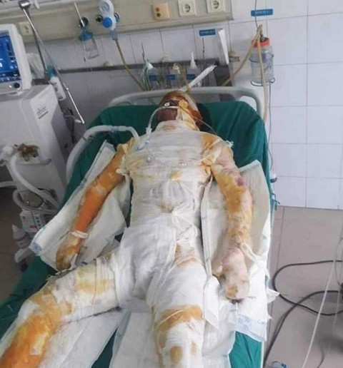Đang giao ca thì sụt lò luyện gang, công nhân bỏng 80% cơ thể - Ảnh 2. Đang giao ca thì sụt lò luyện gang, công nhân bỏng 80% cơ thể - Ảnh 2.