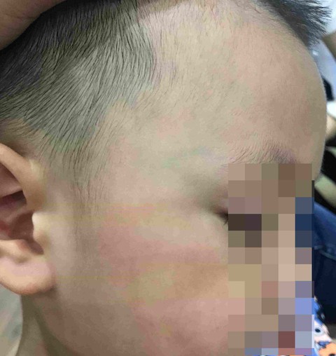 Buộc thôi việc giáo viên tát trẻ mầm non bầm tím môi - Ảnh 1. Buộc thôi việc giáo viên tát trẻ mầm non bầm tím môi - Ảnh 1.