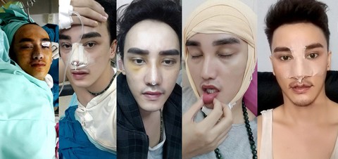 Chàng trai nghiện phẫu thuật thẩm mỹ: đã 16 lần dao kéo - Ảnh 2. Chàng trai nghiện phẫu thuật thẩm mỹ: đã 16 lần dao kéo - Ảnh 2.
