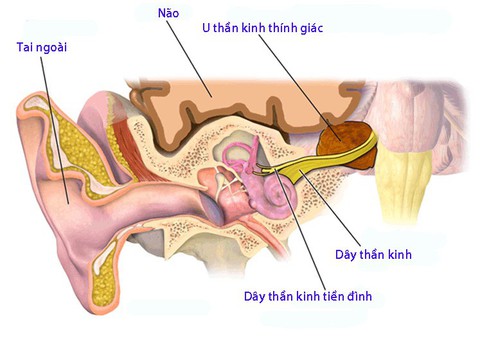 U tế bào thần kinh thính giác - Ảnh 1. U tế bào thần kinh thính giác - Ảnh 1.