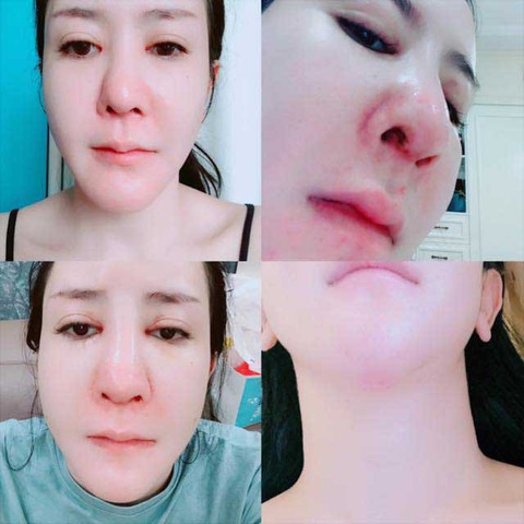 Phẫu thuật thẩm mỹ ở giới trẻ: Trăm chuyện bi hài vì biến chứng, biến dạng - Ảnh 1. Phẫu thuật thẩm mỹ ở giới trẻ: Trăm chuyện bi hài vì biến chứng, biến dạng - Ảnh 1.