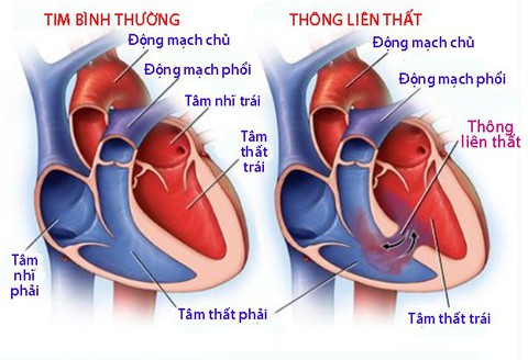 Dị tật thông liên thất - Ảnh 1. Dị tật thông liên thất - Ảnh 1.