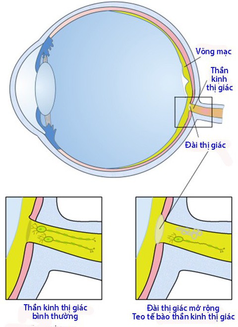 Teo dây thần kinh thị giác: Bệnh thường gặp ở người lớn tuổi - Ảnh 1. Teo dây thần kinh thị giác: Bệnh thường gặp ở người lớn tuổi - Ảnh 1.