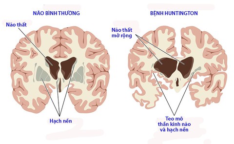 Bệnh Huntington - Ảnh 1. Bệnh Huntington - Ảnh 1.