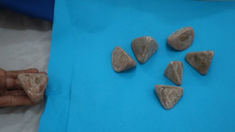 Phẫu thuật lấy ra 7 viên sỏi nặng nửa ký trong bàng quang bệnh nhân - Ảnh 2. Phẫu thuật lấy ra 7 viên sỏi nặng nửa ký trong bàng quang bệnh nhân - Ảnh 2.
