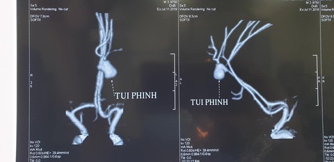 Bác sĩ kinh ngạc khi gặp ca phình mạch não vỡ ở trẻ 3 tuổi - Ảnh 1. Bác sĩ kinh ngạc khi gặp ca phình mạch não vỡ ở trẻ 3 tuổi - Ảnh 1.