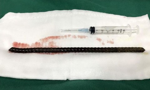 Nhảy từ trên xe xuống, thanh niên bị thanh sắt xuyên từ đùi lên bụng - Ảnh 1. Nhảy từ trên xe xuống, thanh niên bị thanh sắt xuyên từ đùi lên bụng - Ảnh 1.