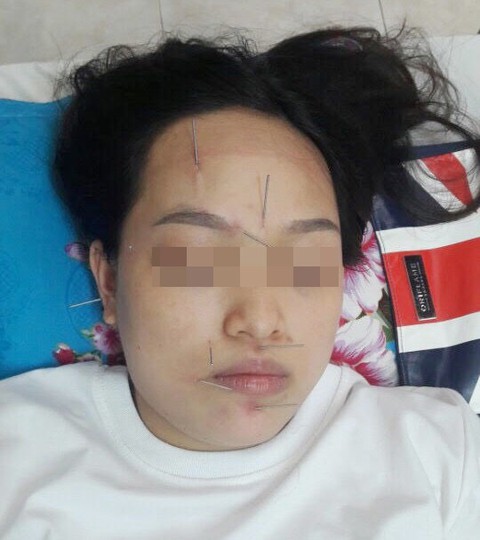 Bỗng dưng méo mặt phải đi khám ngay, đừng chủ quan cho qua - Ảnh 3. Bỗng dưng méo mặt phải đi khám ngay, đừng chủ quan cho qua - Ảnh 3.