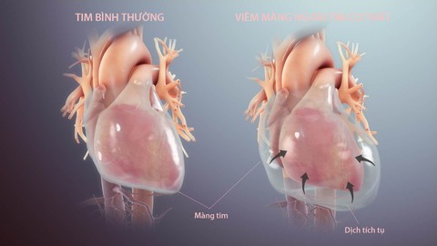 Bệnh viêm màng ngoài tim co thắt có thể dẫn tới suy tim - Ảnh 1. Bệnh viêm màng ngoài tim co thắt có thể dẫn tới suy tim - Ảnh 1.