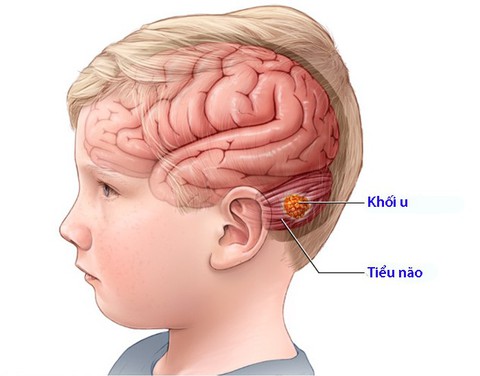 U tiểu não ở trẻ em - Ảnh 1. U tiểu não ở trẻ em - Ảnh 1.
