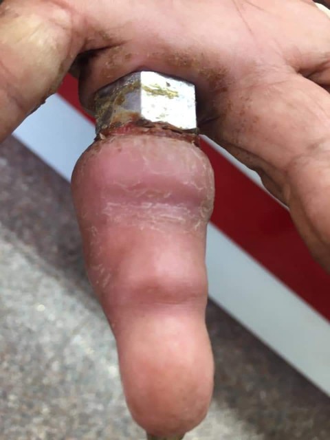 Bà cụ 75 tuổi lấy ốc bulông làm nhẫn suýt mất ngón tay - Ảnh 1. Bà cụ 75 tuổi lấy ốc bulông làm nhẫn suýt mất ngón tay - Ảnh 1.