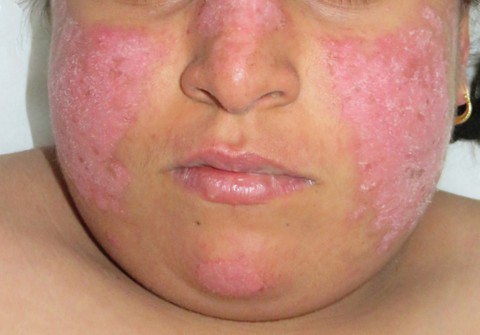 Lupus ban đỏ dạng đĩa - Ảnh 1. Lupus ban đỏ dạng đĩa - Ảnh 1.