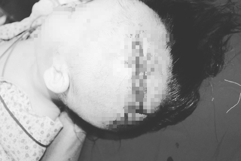 Bé 2 tuổi bị chó nuôi cắn rách mặt, lộ cả xương sọ - Ảnh 1. Bé 2 tuổi bị chó nuôi cắn rách mặt, lộ cả xương sọ - Ảnh 1.