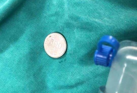Bé trai 37 tháng nuốt đồng xu vào họng - Ảnh 2. Bé trai 37 tháng nuốt đồng xu vào họng - Ảnh 2.