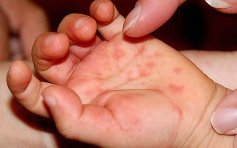 Bệnh mùa mưa nguy hiểm nhất do muỗi vằn gây ra - Ảnh 3. Bệnh mùa mưa nguy hiểm nhất do muỗi vằn gây ra - Ảnh 3.