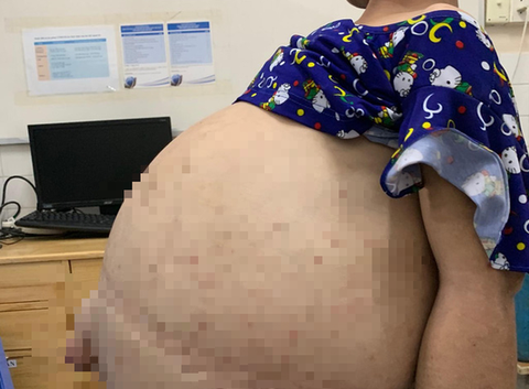 Cô gái 19 tuổi từng mang bụng chứa hơn 40 lít nước như được tái sinh - Ảnh 3. Cô gái 19 tuổi từng mang bụng chứa hơn 40 lít nước như được tái sinh - Ảnh 3.
