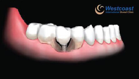 Những biến chứng nguy hiểm khi trồng răng thất bại - Ảnh 1. Những biến chứng nguy hiểm khi trồng răng thất bại - Ảnh 1.