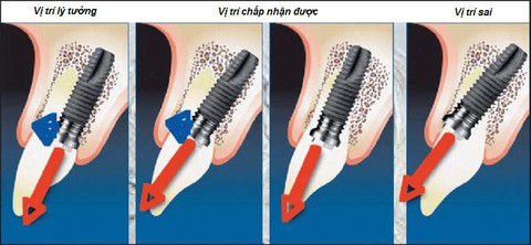 Những biến chứng nguy hiểm khi trồng răng thất bại - Ảnh 2. Những biến chứng nguy hiểm khi trồng răng thất bại - Ảnh 2.