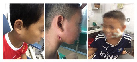 Phát hiện số ca bệnh whitmore đang gia tăng - Ảnh 1. Phát hiện số ca bệnh whitmore đang gia tăng - Ảnh 1.
